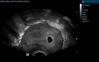 Mindray Ultrasound Z5