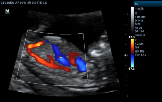 Mindray Ultrasound Z5