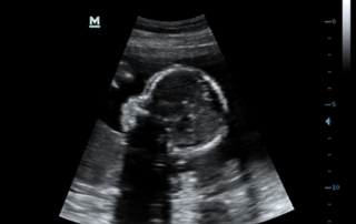 Mindray Ultrasound Z5