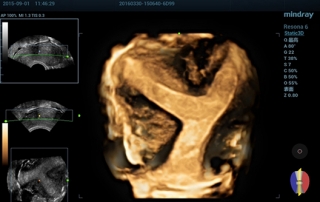 Mindray Ultrasound Resona 6