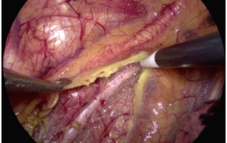 Mindray HyPixel™ U1 Endoscope